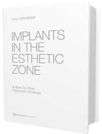 Implants in the Esthetic Zone A Step by Step Treatment Strategy